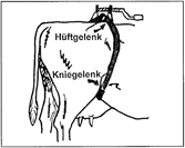 Hueftfessel anlegen Skizze
